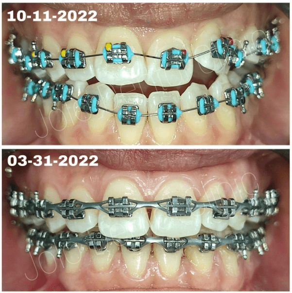 Jolo Dental Clinic Braces Treatment Before and After