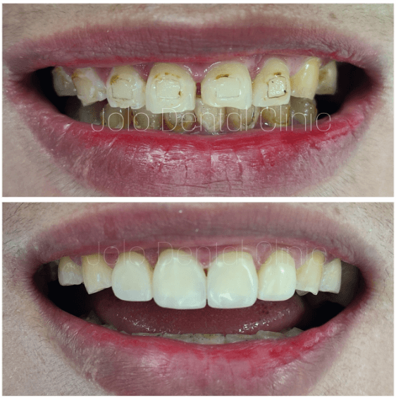 Jolo Dental Clinic Direct Teeth Veneers - Dental Esthetics