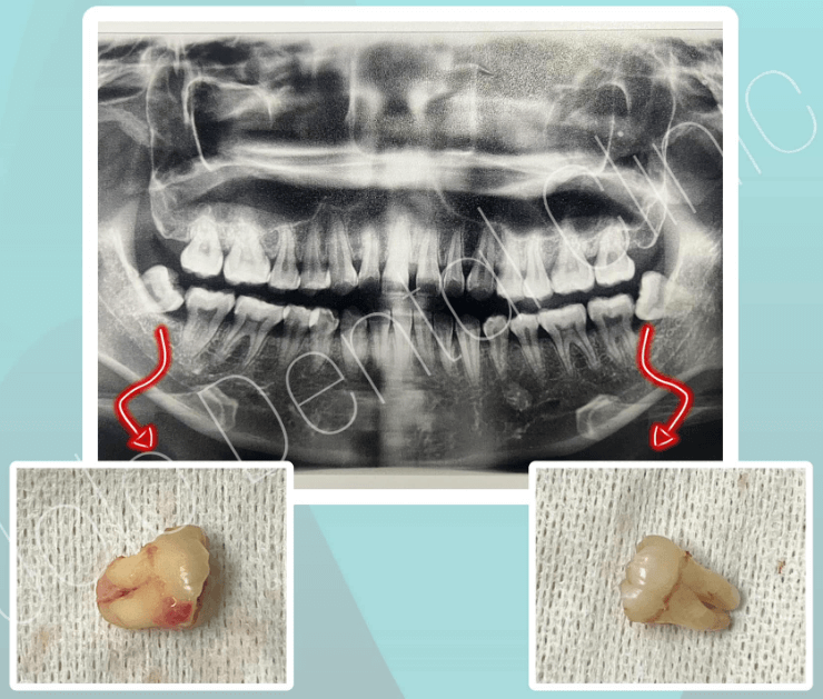 Jolo Dental Clinic Wisdom Tooth Surgery